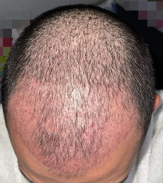 شكل الشعر المزروع بعد شهرين 