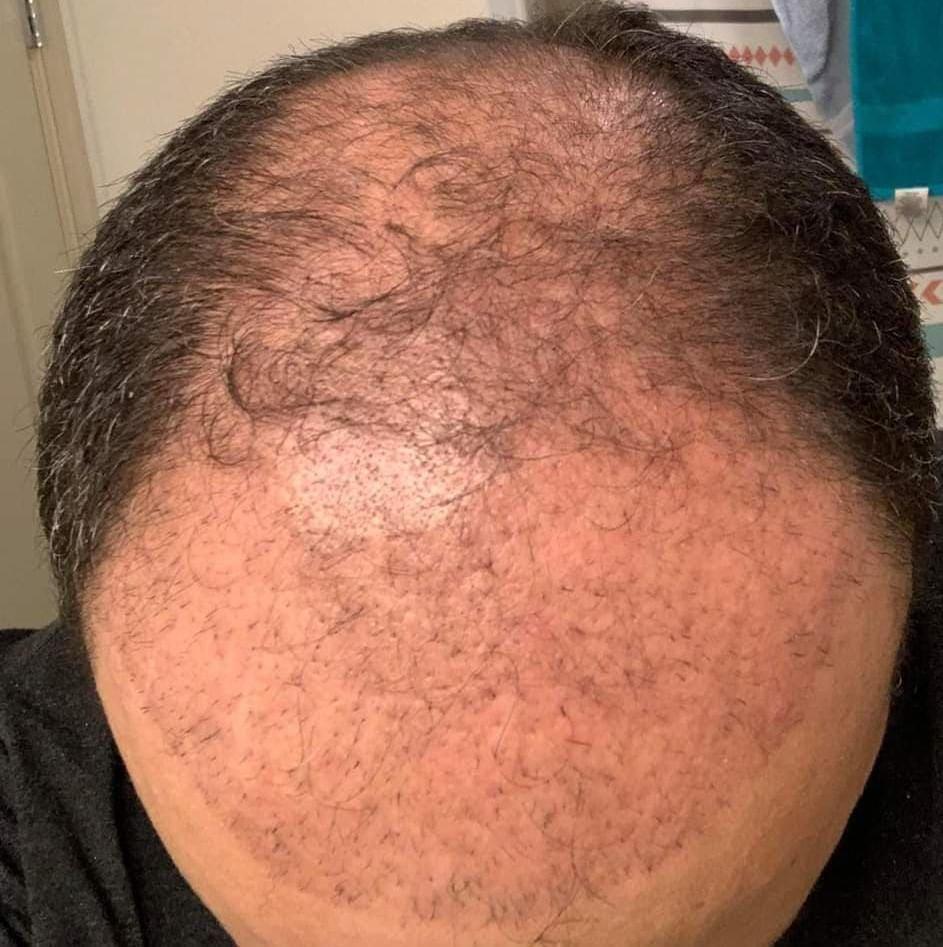 شكل الشعر المزروع بعد شهرين 