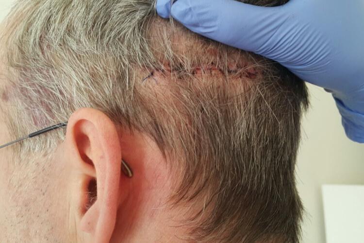 زراعة الشعر بتقنية الشريحه