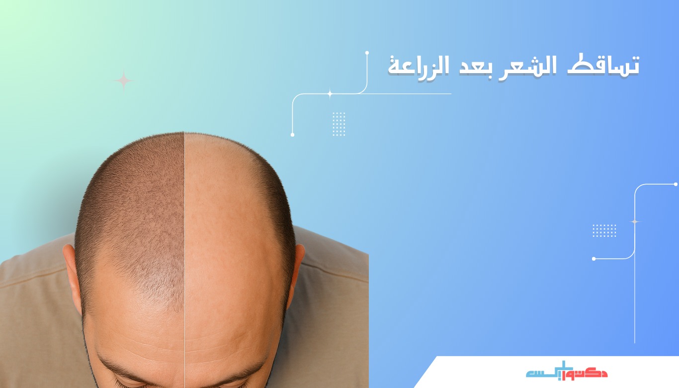 تساقط الشعر بعد الزراعة