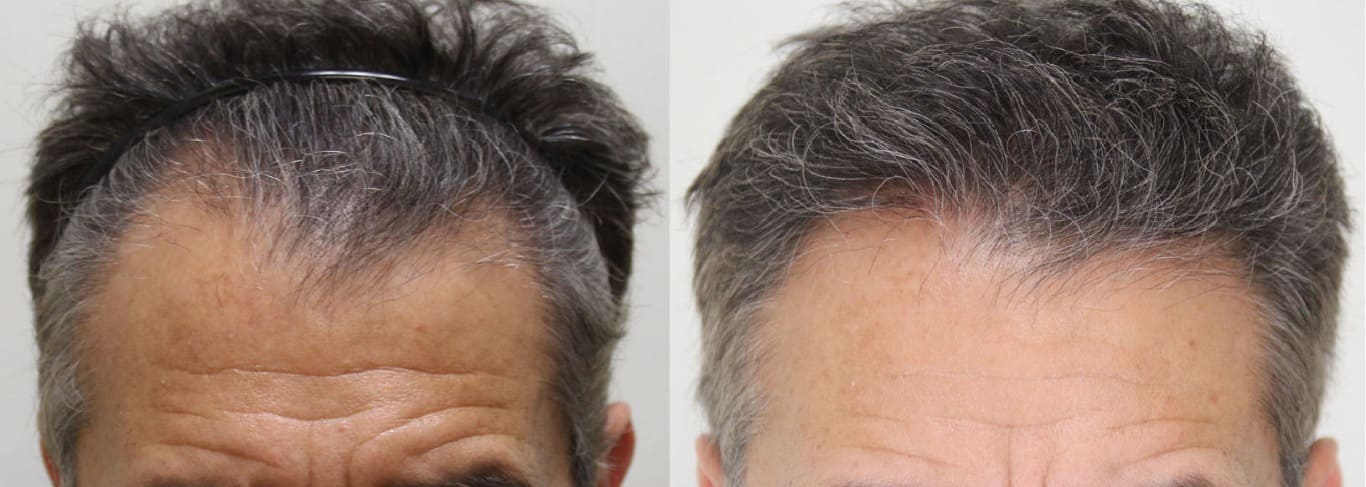 زراعة الشعر بالاقتطاف