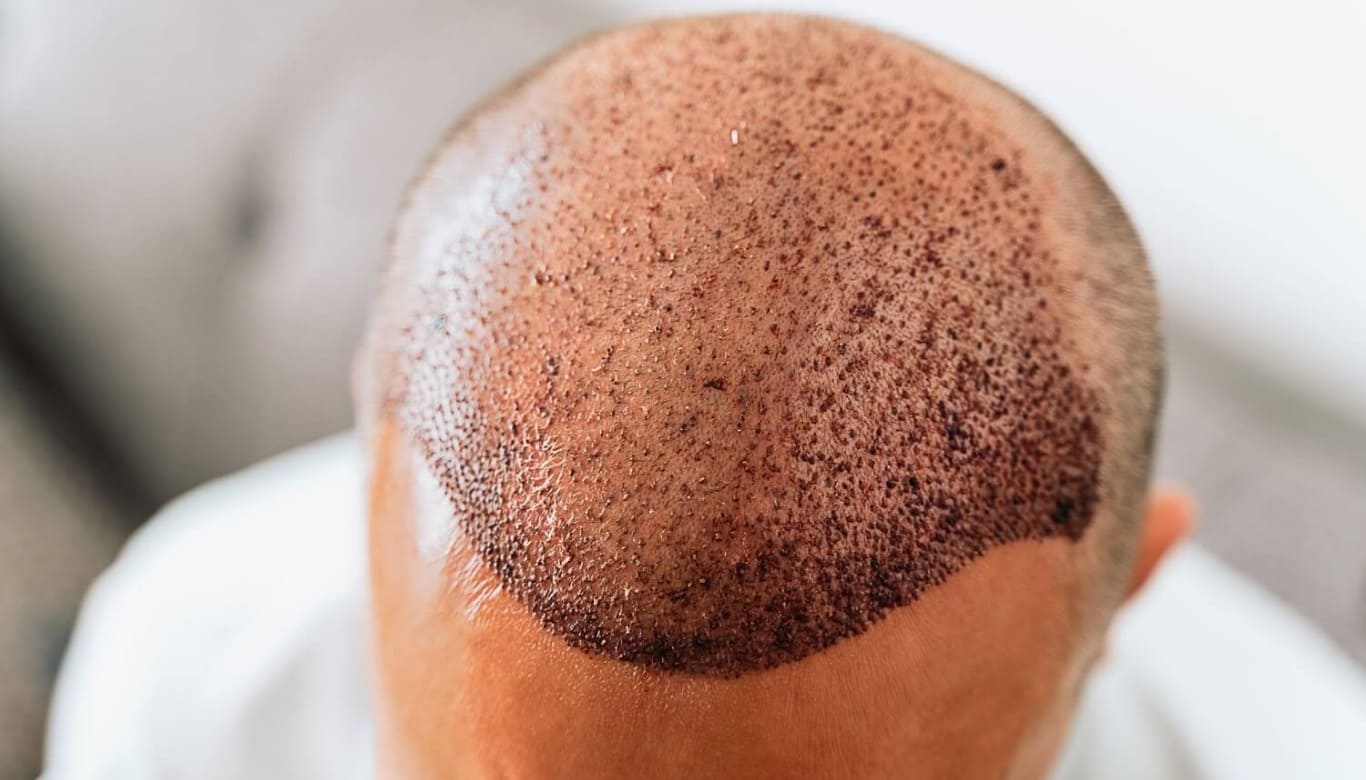 طرق العناية بالشعر المزروع بعد عملية زراعة الشعر في الأسبوع الأول. 