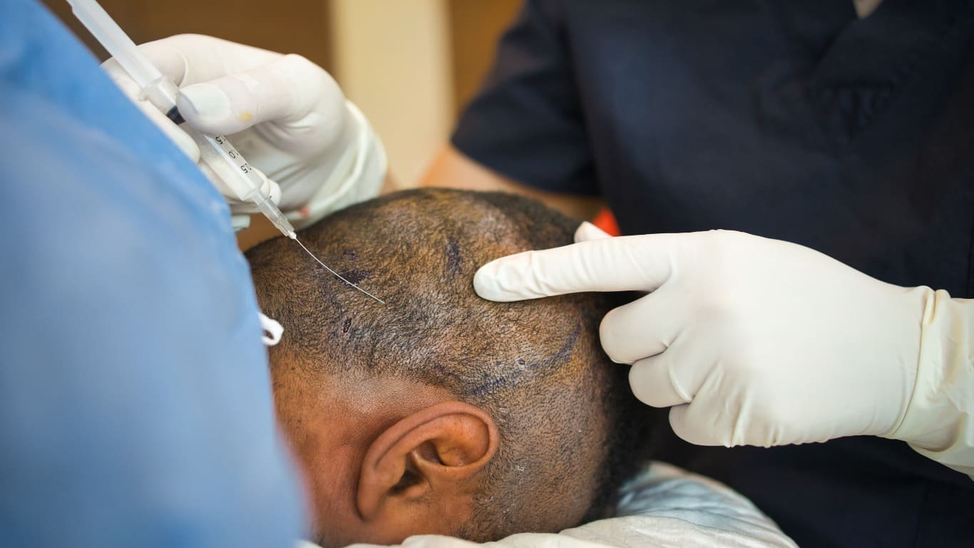 عيوب زراعة الشعر بالاقتطاف وتشوة المنطقة المانح
