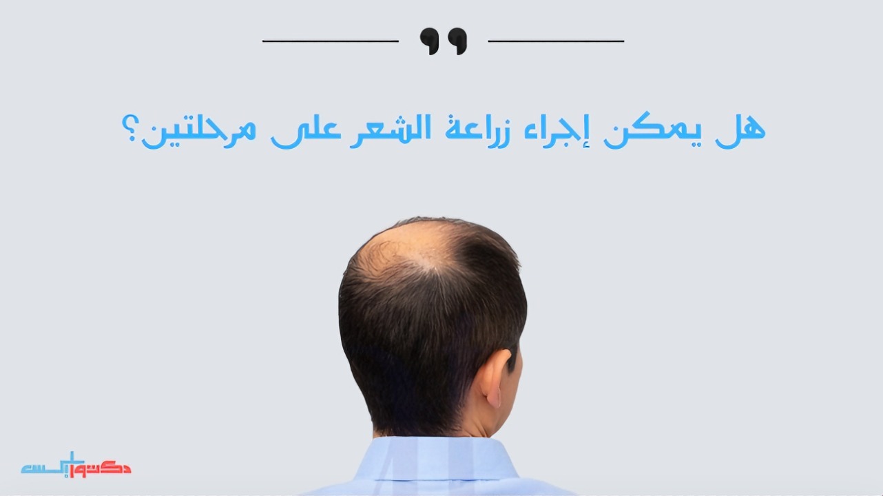 زراعة الشعر على مرحلتين