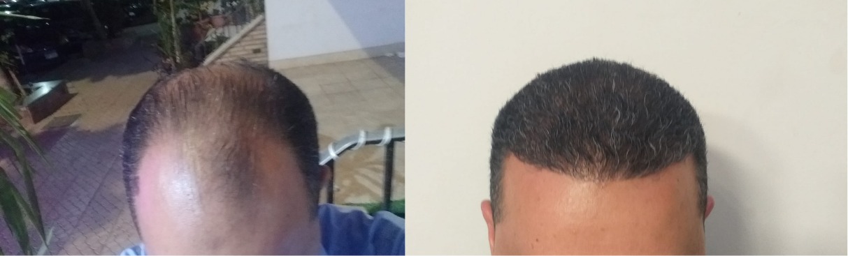 نتائج دكتور عبد الوهاب سعيد لزراعة الشعر