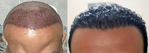 نتائج زراعة الشعر مع دكتور محمد ثروت
