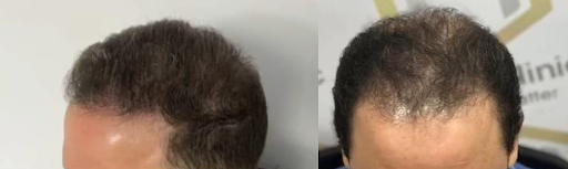 نتائح زراعة الشعر مع دكتور شريف حجازي
