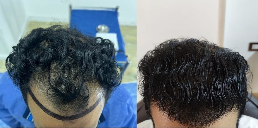 تجربتي مع مركز كينج هير لزراعة الشعر