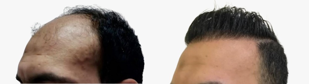 نتائج زراعة الشعر مع دكتور أحمد قابيل لزراعة الشعر
