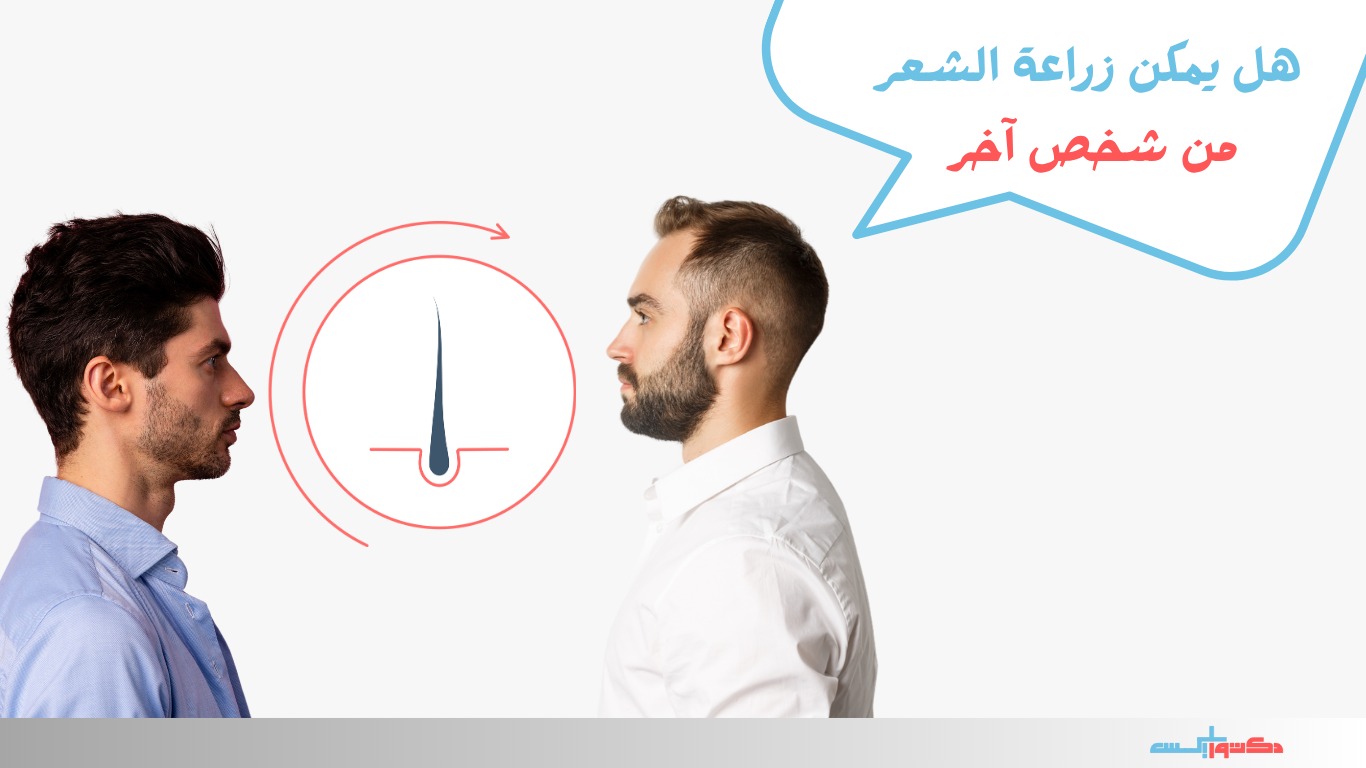 هل يمكن زراعة الشعر من شخص آخر